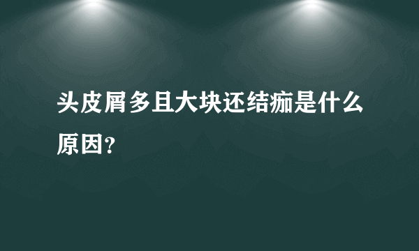 头皮屑多且大块还结痂是什么原因？