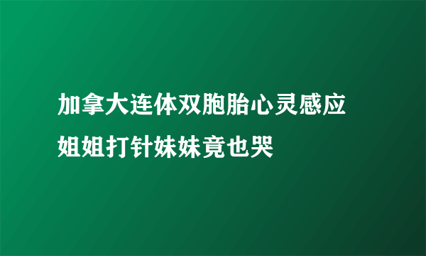 加拿大连体双胞胎心灵感应 姐姐打针妹妹竟也哭