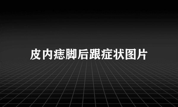 皮内痣脚后跟症状图片