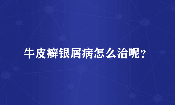 牛皮癣银屑病怎么治呢？