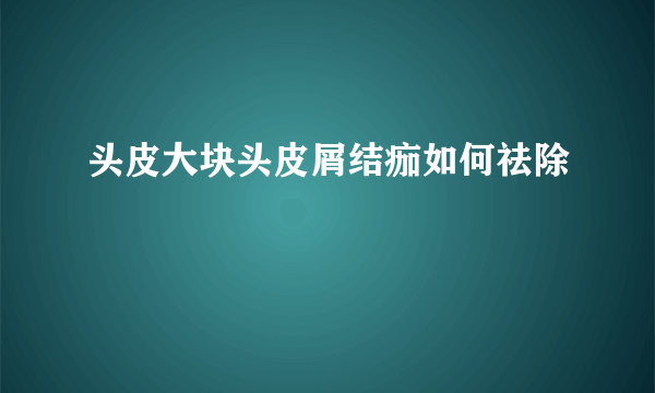 头皮大块头皮屑结痂如何祛除