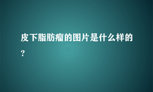 皮下脂肪瘤的图片是什么样的？