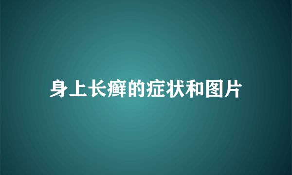 身上长癣的症状和图片