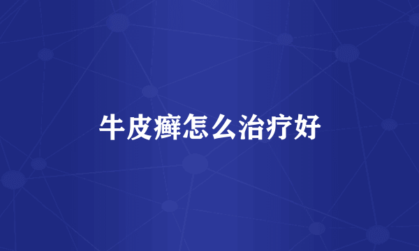 牛皮癣怎么治疗好